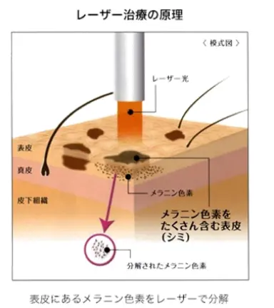 レーザーフェイシャル